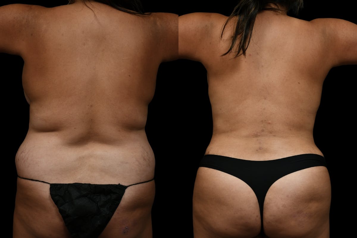 Mommy Makeover Before & After Gallery - Patient 200783 - Image 5