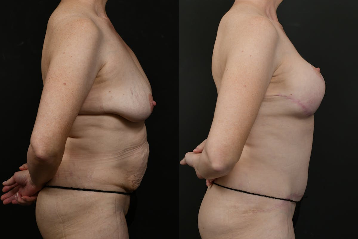 Reductive Augmentation Before & After Gallery - Patient 391312 - Image 4