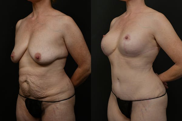 Reductive Augmentation Before & After Gallery - Patient 391312 - Image 1