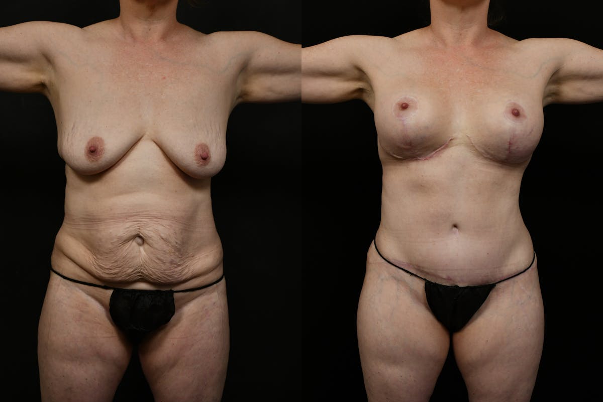 Tummy Tuck Before & After Gallery - Patient 323176 - Image 1