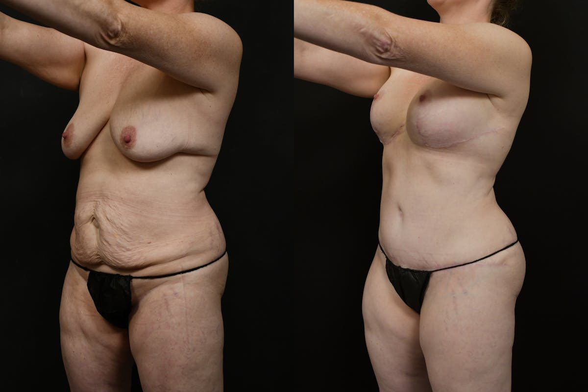 Tummy Tuck Before & After Gallery - Patient 323176 - Image 2