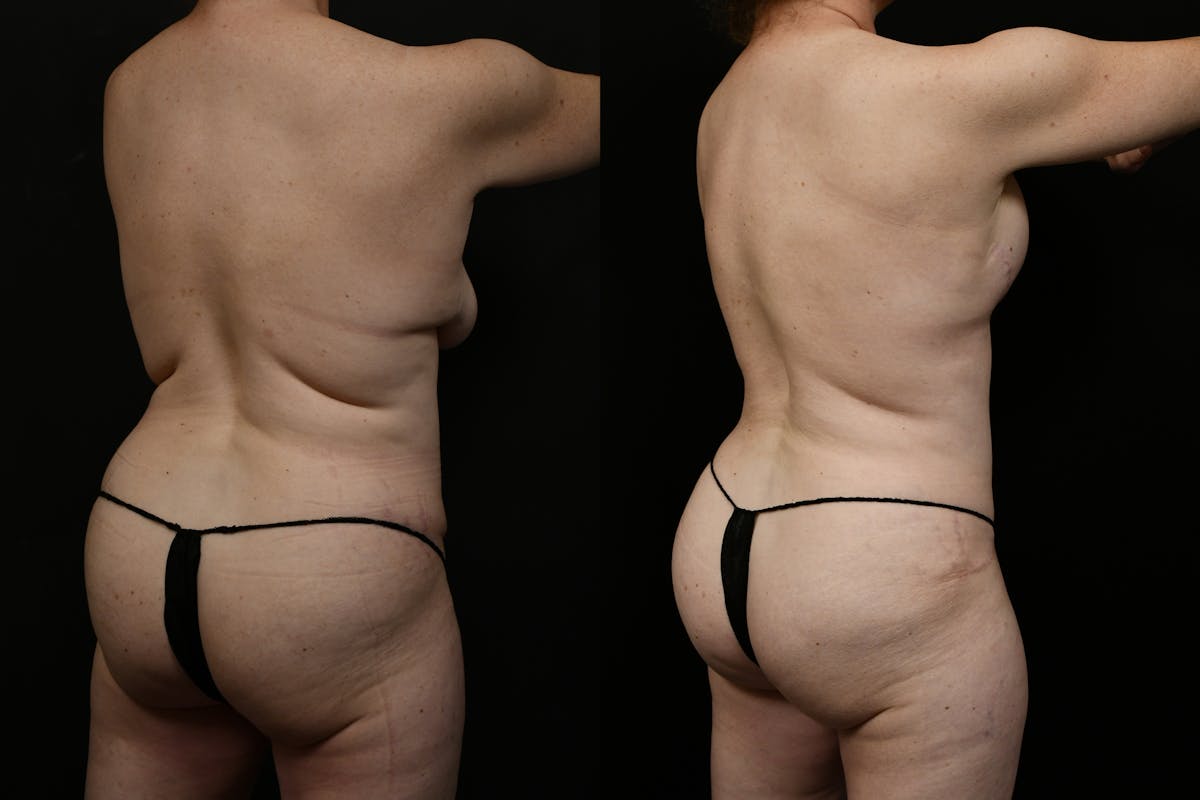 Tummy Tuck Before & After Gallery - Patient 323176 - Image 6