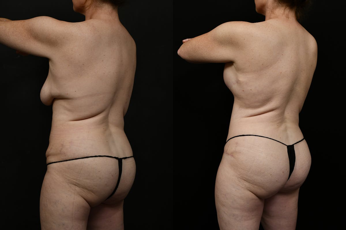 Tummy Tuck Before & After Gallery - Patient 323176 - Image 4