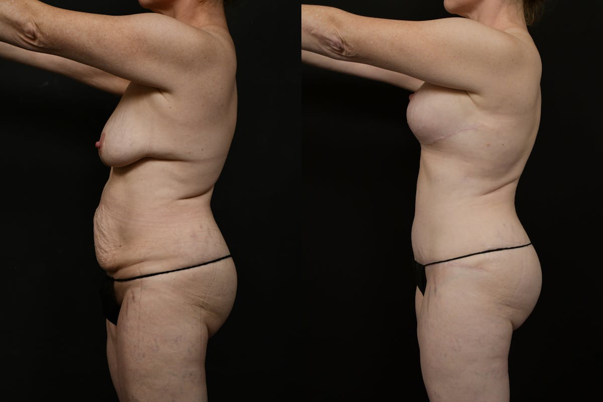 Tummy Tuck Before & After Gallery - Patient 323176 - Image 3