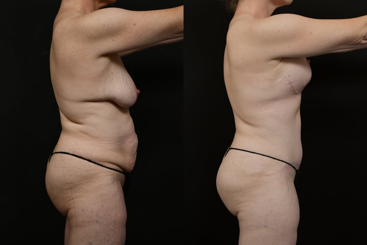 Tummy Tuck Before & After Gallery - Patient 323176 - Image 7