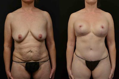 Breast Lift Before & After Gallery - Patient 257221 - Image 1