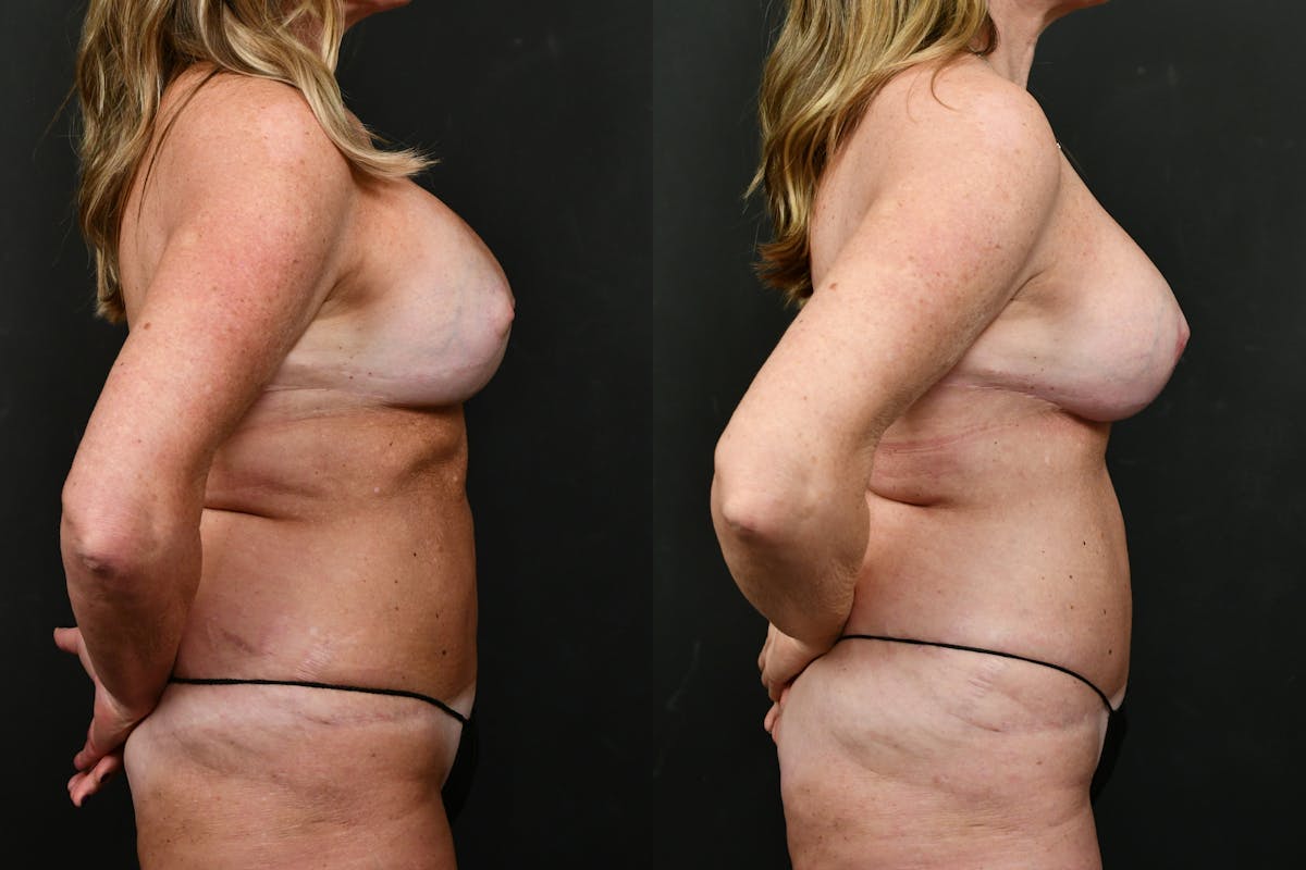 Breast Revision Before & After Gallery - Patient 341975 - Image 3