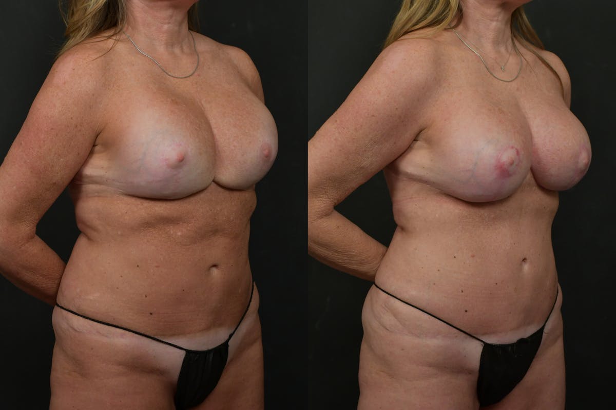 Breast Revision Before & After Gallery - Patient 341975 - Image 2