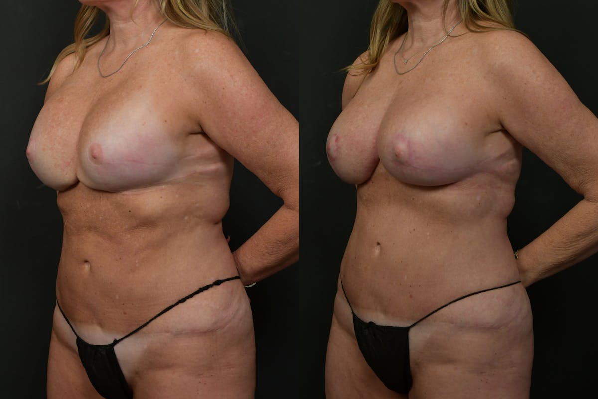 Breast Revision Before & After Gallery - Patient 341975 - Image 4