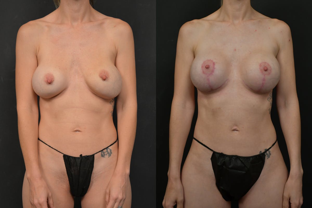Breast Revision Before & After Gallery - Patient 620883 - Image 1