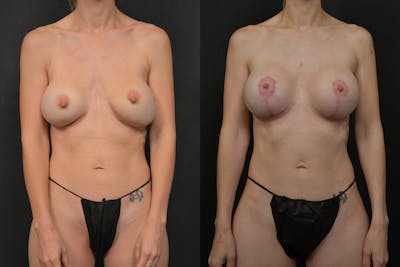Breast Revision Before & After Gallery - Patient 620883 - Image 1