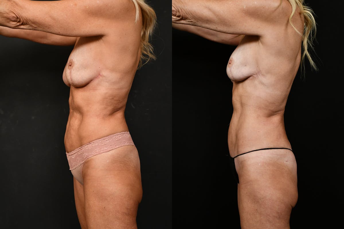 Reverse Tummy Tuck Before & After Gallery - Patient 134518 - Image 3