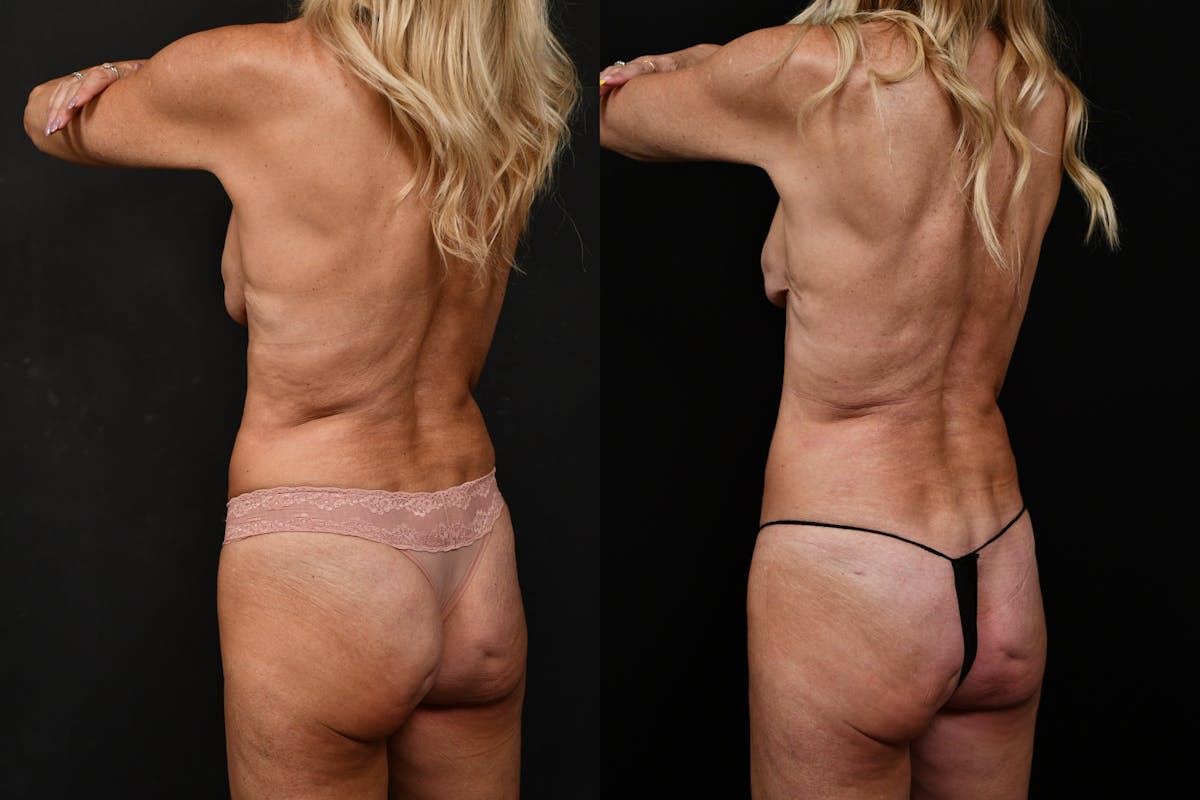 Reverse Tummy Tuck Before & After Gallery - Patient 134518 - Image 4