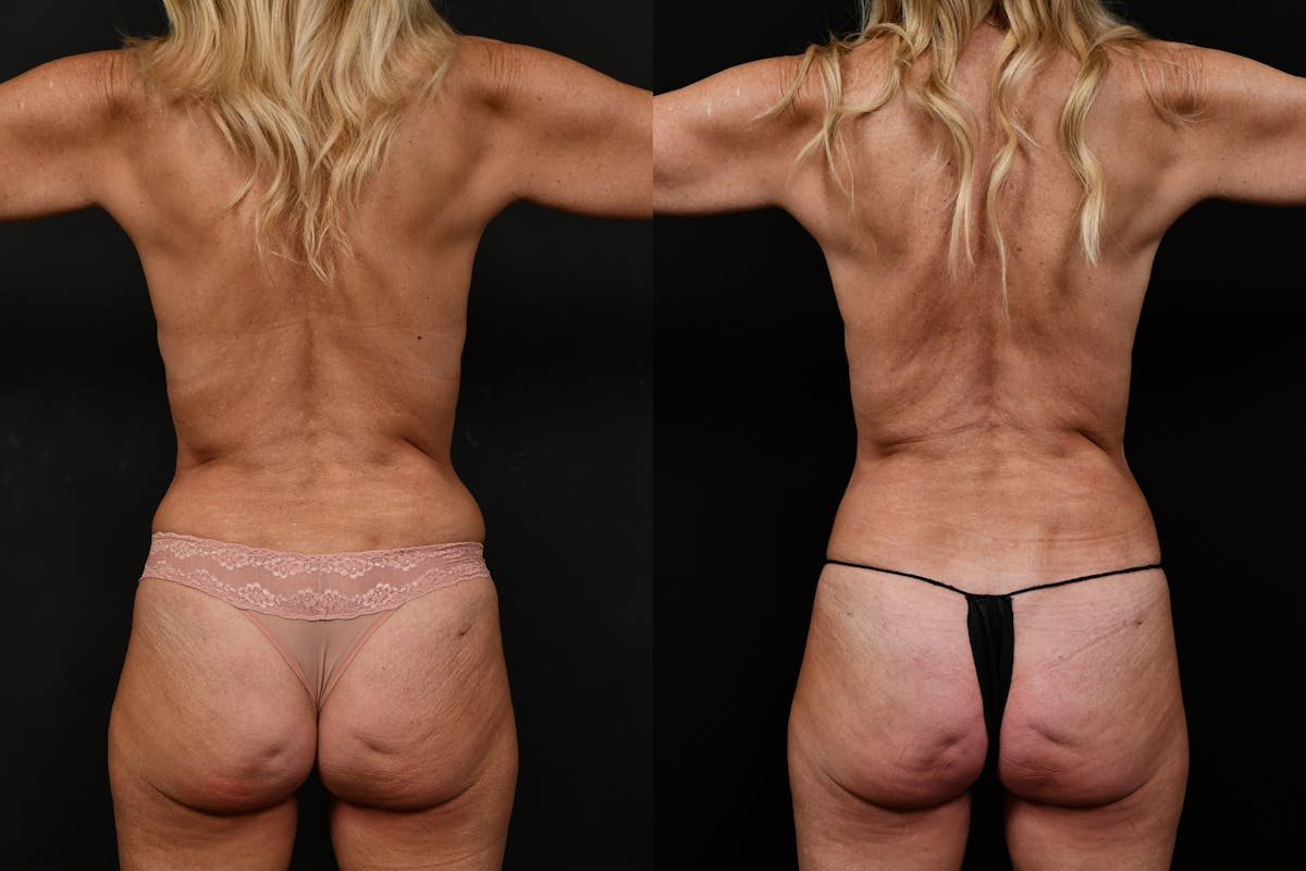 Reverse Tummy Tuck Before & After Gallery - Patient 134518 - Image 5
