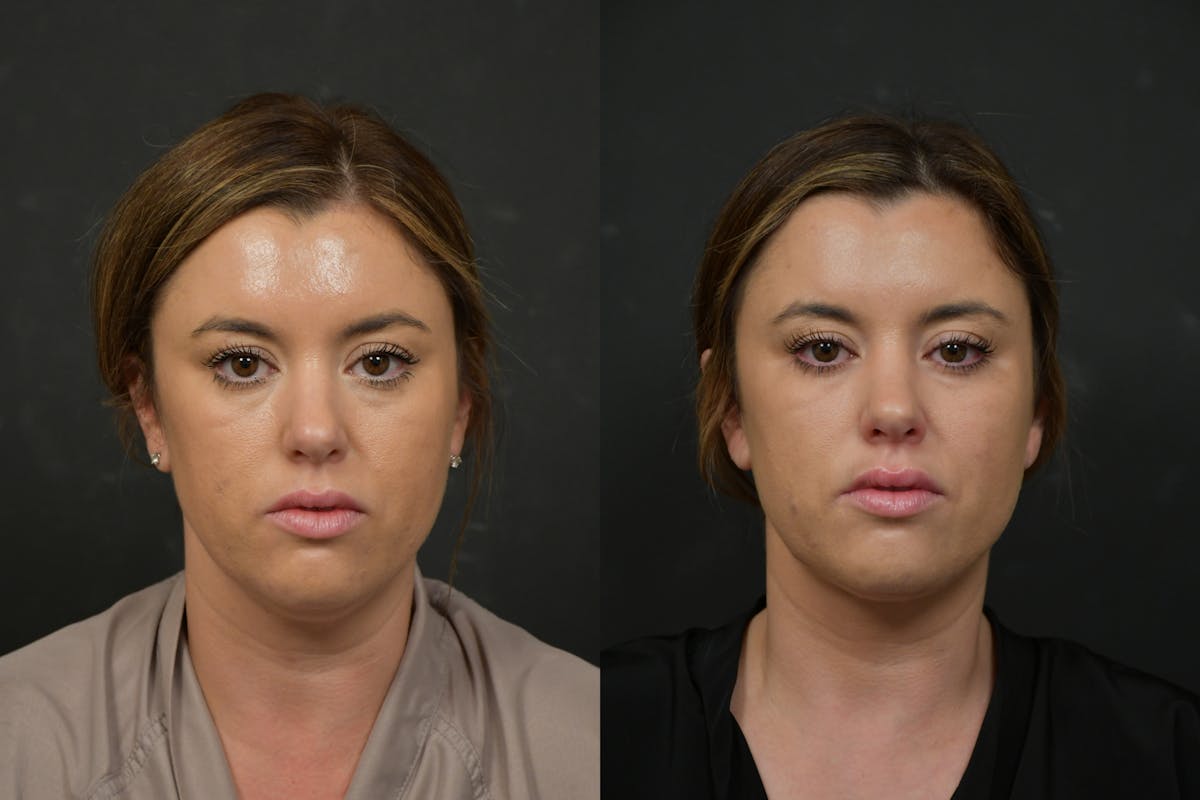 Neck Lift Before & After Gallery - Patient 106522 - Image 5