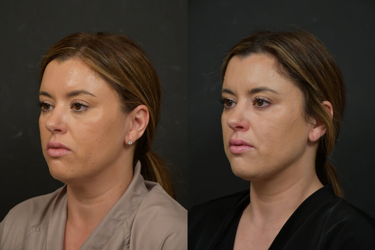 Neck Lift Before & After Gallery - Patient 106522 - Image 1