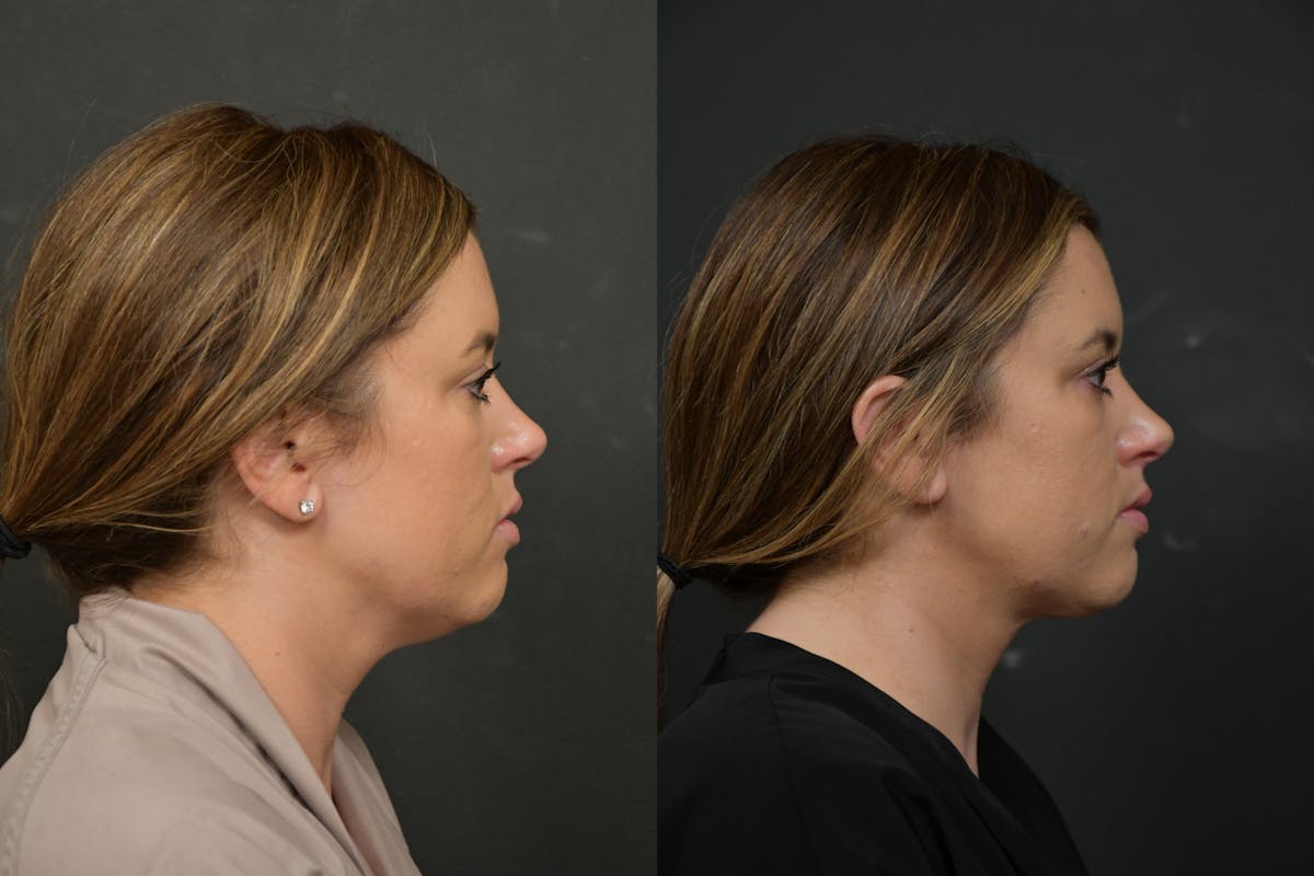 Neck Lift Before & After Gallery - Patient 106522 - Image 4