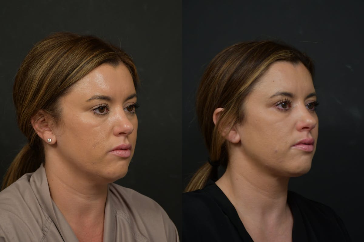 Neck Lift Before & After Gallery - Patient 106522 - Image 3