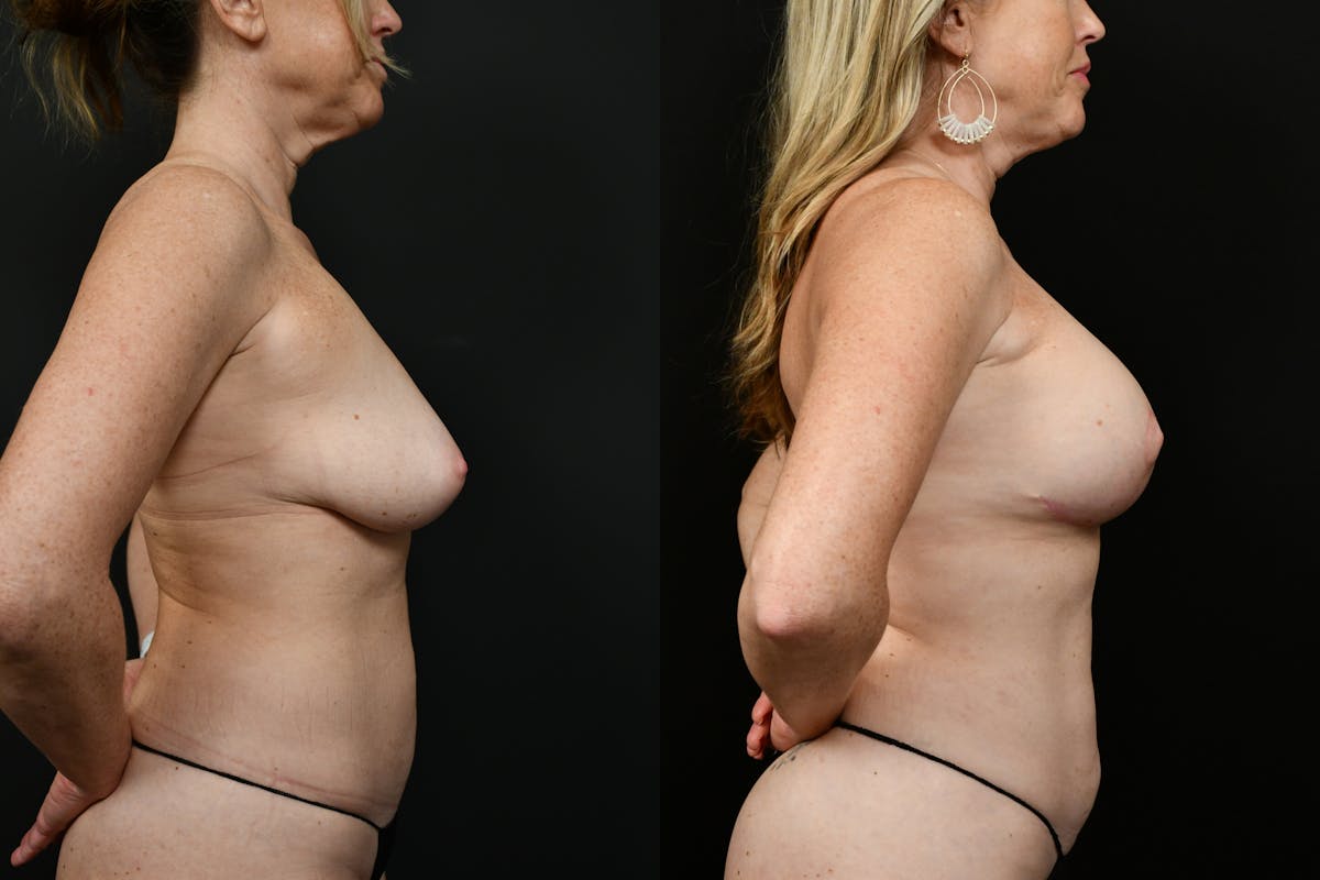 Reductive Augmentation Before & After Gallery - Patient 786391 - Image 5