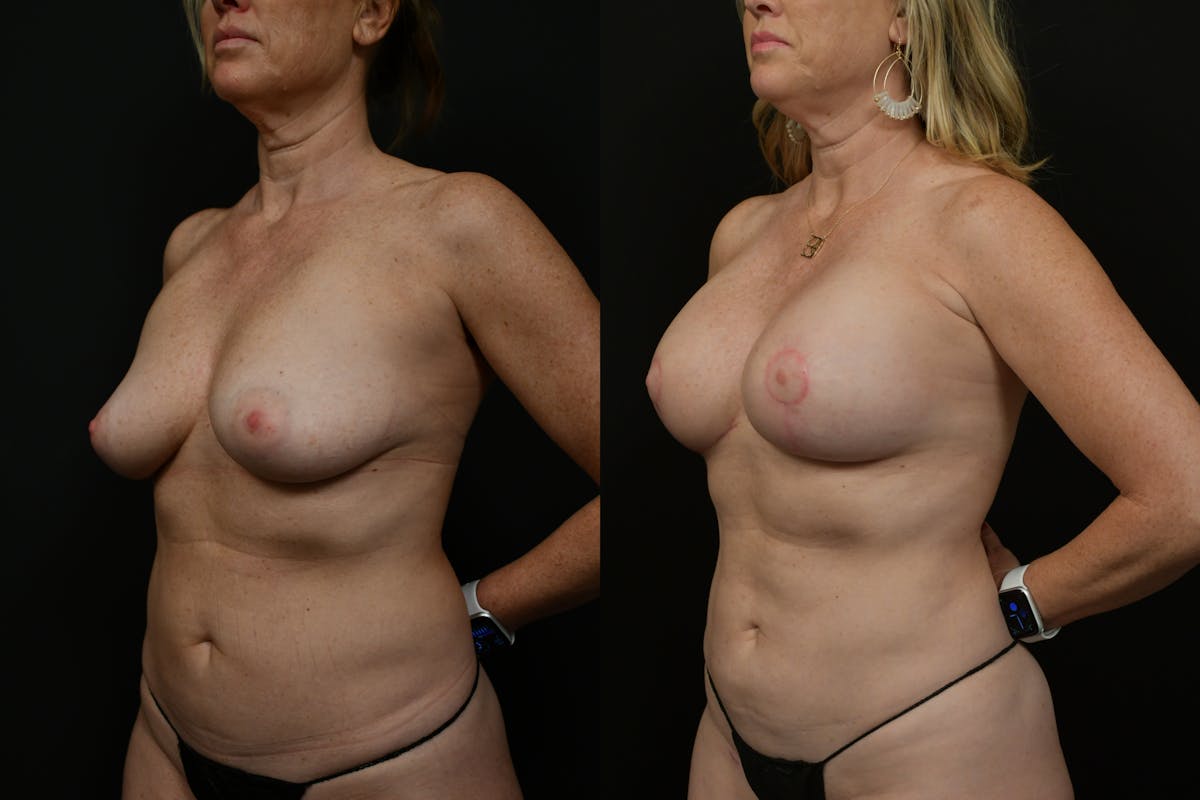 Reductive Augmentation Before & After Gallery - Patient 786391 - Image 2