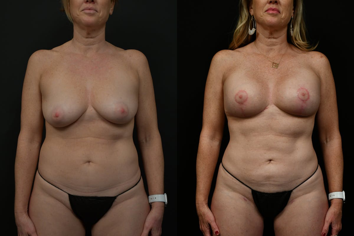 Reductive Augmentation Before & After Gallery - Patient 786391 - Image 1