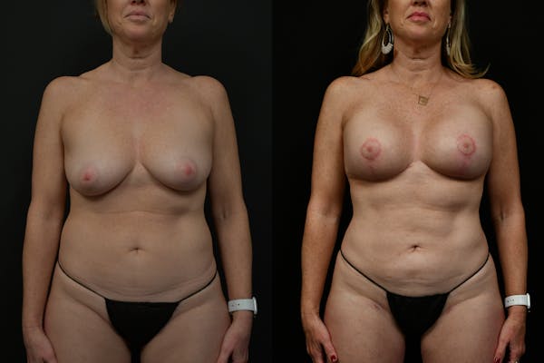 Reductive Augmentation Before & After Gallery - Patient 786391 - Image 1