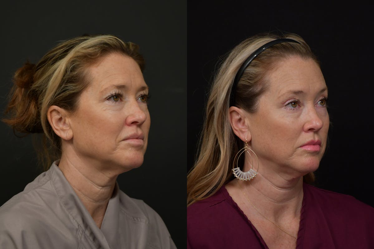 Brow Lift Before & After Gallery - Patient 221733 - Image 2