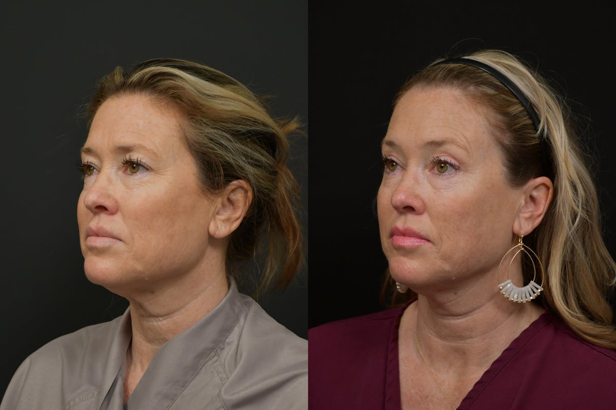 Brow Lift Before & After Gallery - Patient 221733 - Image 4