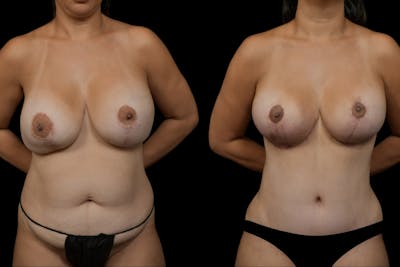 Reductive Augmentation Before & After Gallery - Patient 370321 - Image 1
