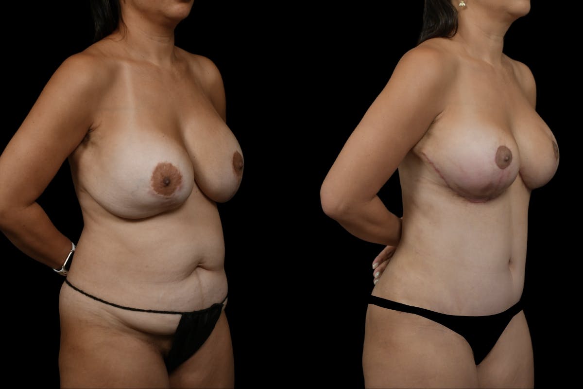 Breast Lift Before & After Gallery - Patient 372219 - Image 2