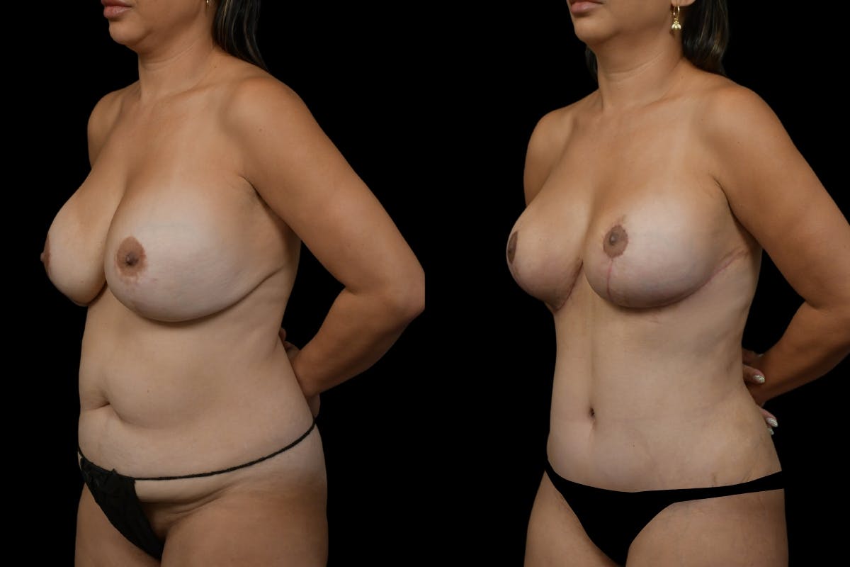 Breast Lift Before & After Gallery - Patient 372219 - Image 4