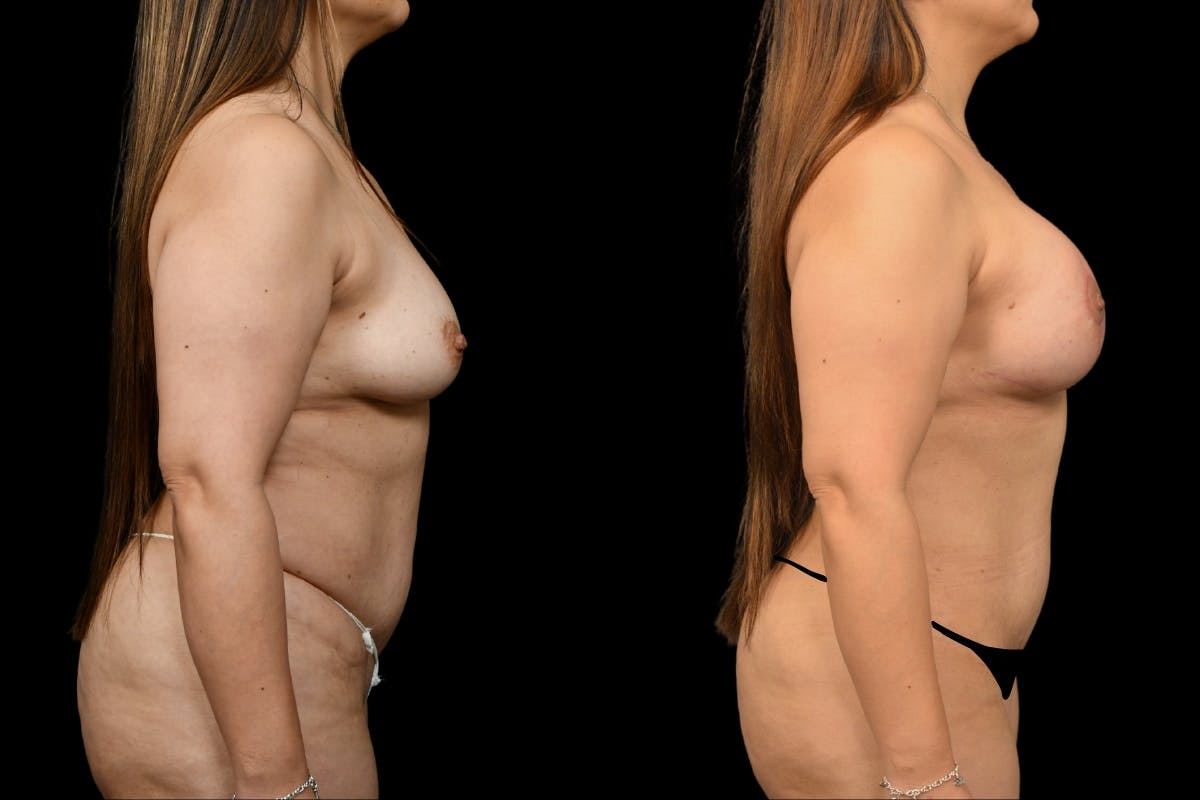 Reductive Augmentation Before & After Gallery - Patient 884523 - Image 3