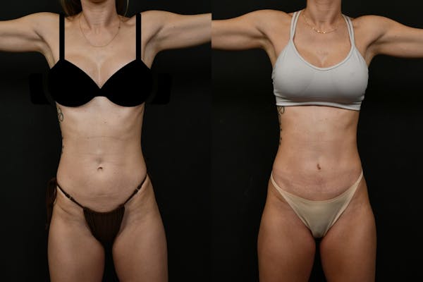 Mini Tummy Tuck (Tunneled) Before & After Gallery - Patient 186914 - Image 1