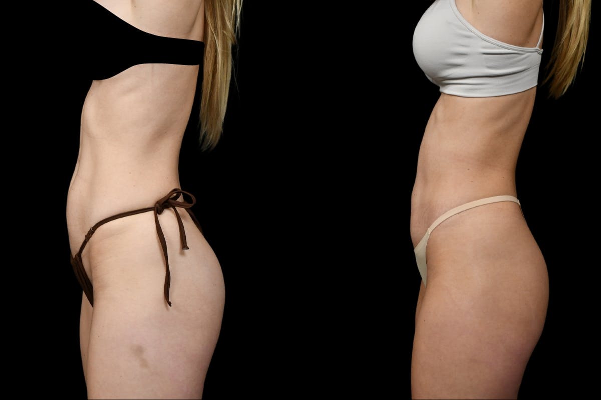 Mini Tummy Tuck (Tunneled) Before & After Gallery - Patient 186914 - Image 3