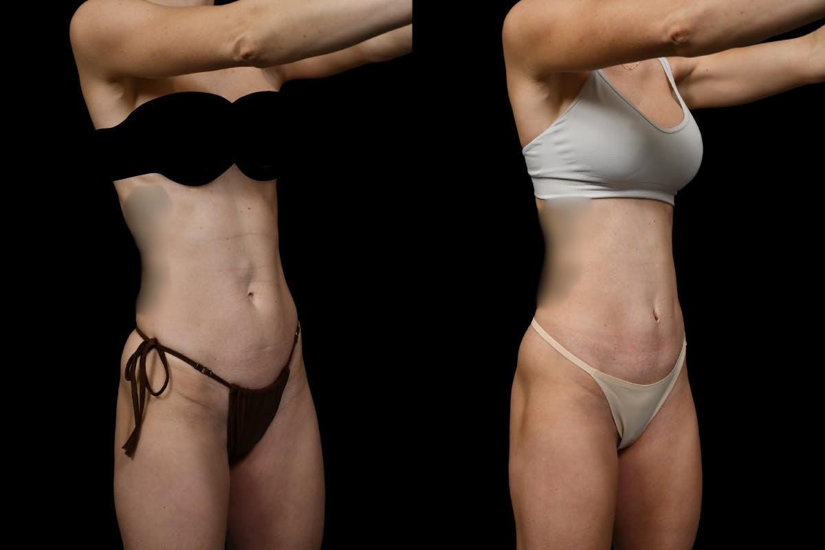 Mini Tummy Tuck (Tunneled) Before & After Gallery - Patient 186914 - Image 4