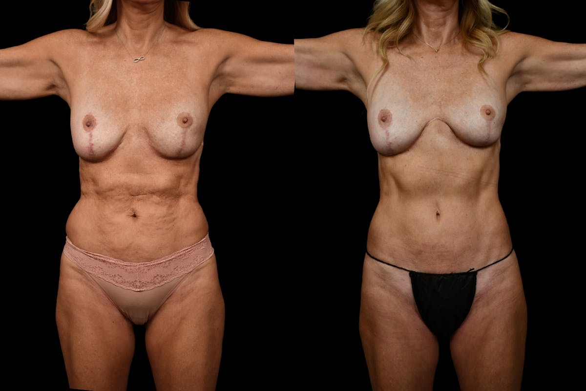 Reverse Tummy Tuck Before & After Gallery - Patient 134518 - Image 1
