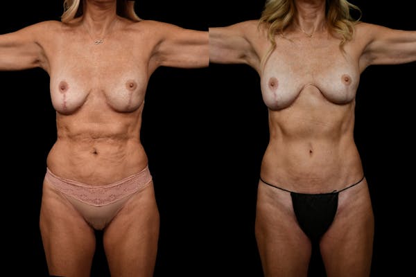 Reverse Tummy Tuck Before & After Gallery - Patient 134518 - Image 1
