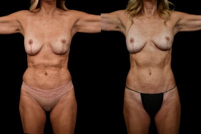 Reverse Tummy Tuck Before & After Gallery - Patient 134518 - Image 1