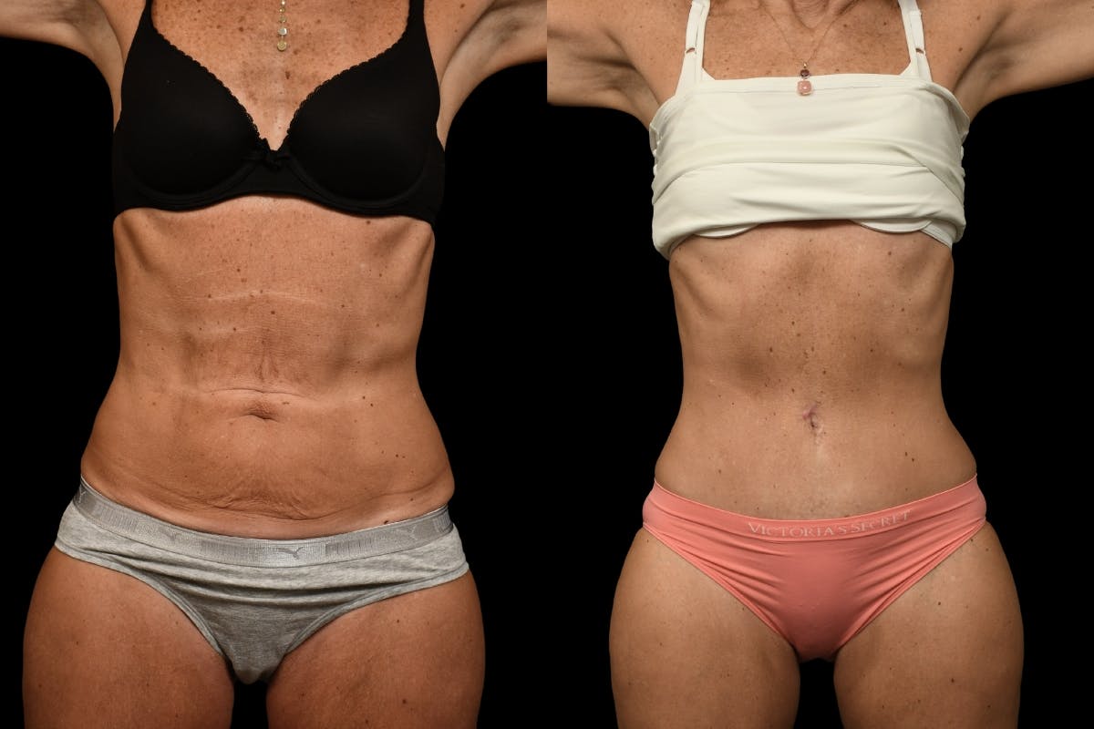 Tummy Tuck Before & After Gallery - Patient 344344 - Image 1