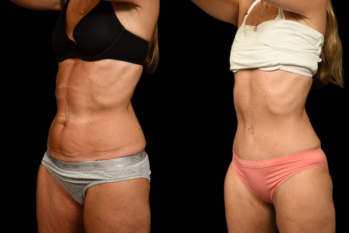 Tummy Tuck Before & After Gallery - Patient 344344 - Image 2