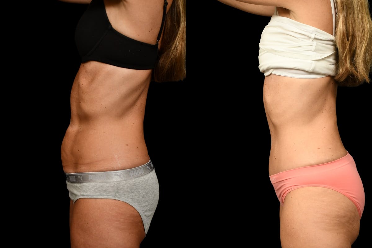 Tummy Tuck Before & After Gallery - Patient 344344 - Image 3