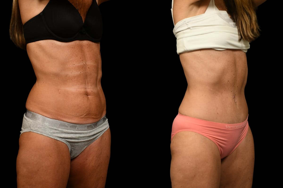 Tummy Tuck Before & After Gallery - Patient 344344 - Image 4