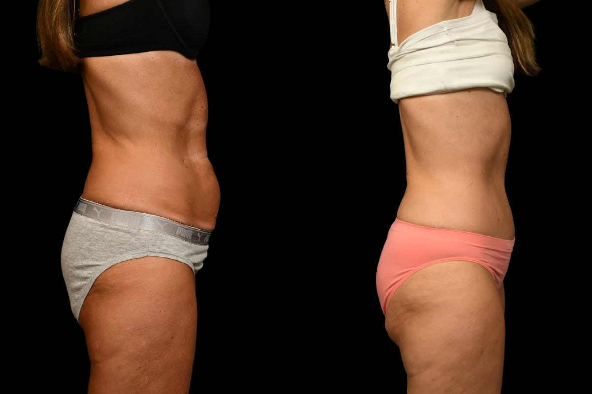 Tummy Tuck Before & After Gallery - Patient 344344 - Image 5