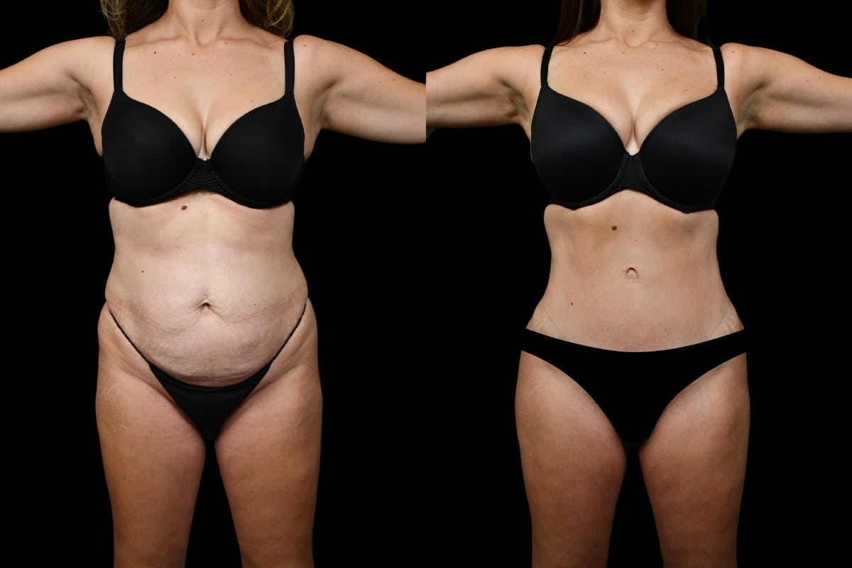 Tummy Tuck Before & After Gallery - Patient 193812 - Image 1