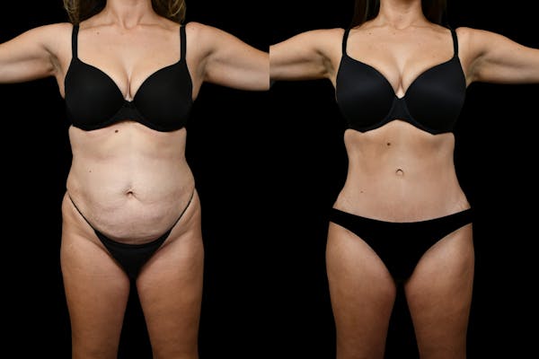 Tummy Tuck Before & After Gallery - Patient 193812 - Image 1