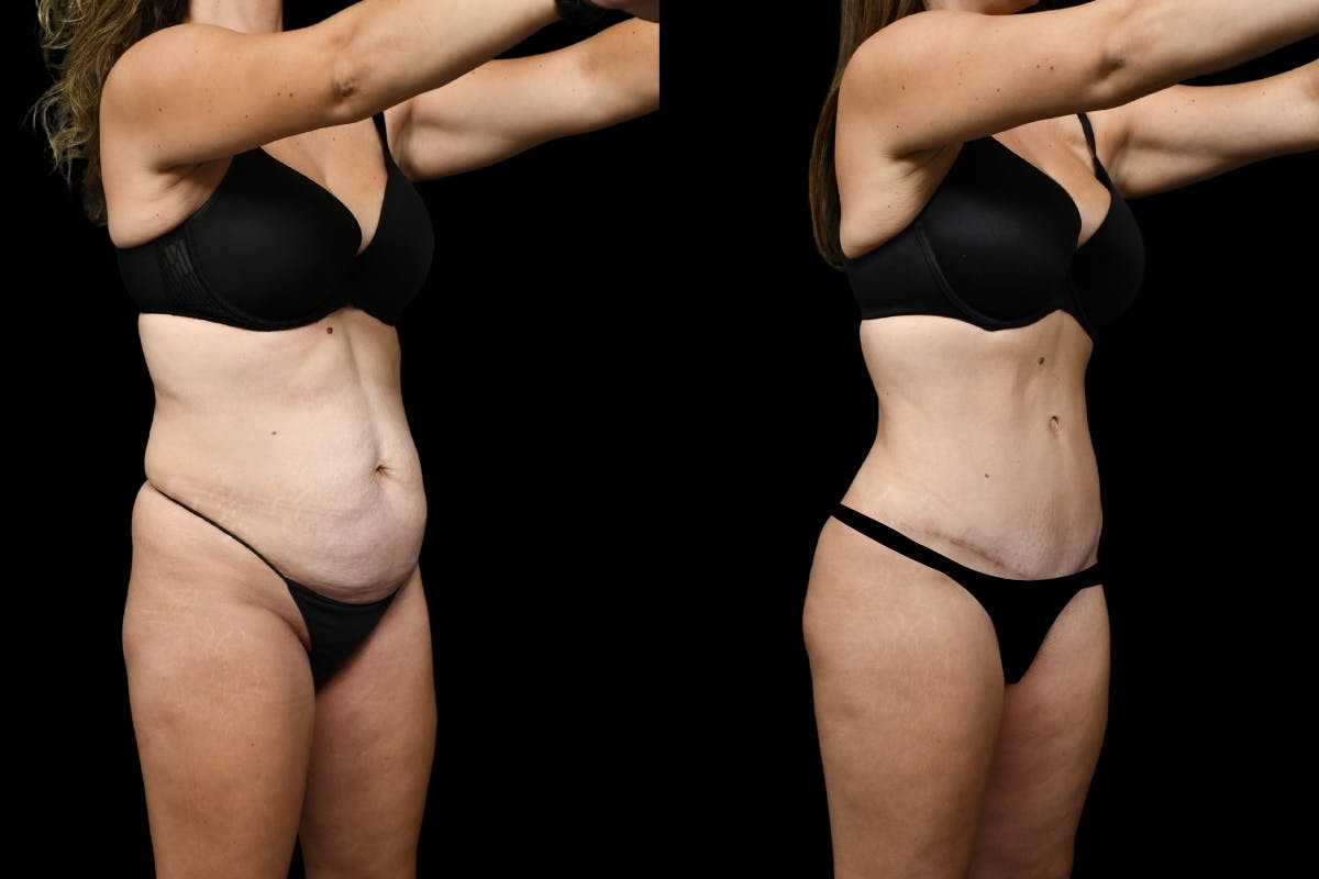 Tummy Tuck Before & After Gallery - Patient 193812 - Image 2
