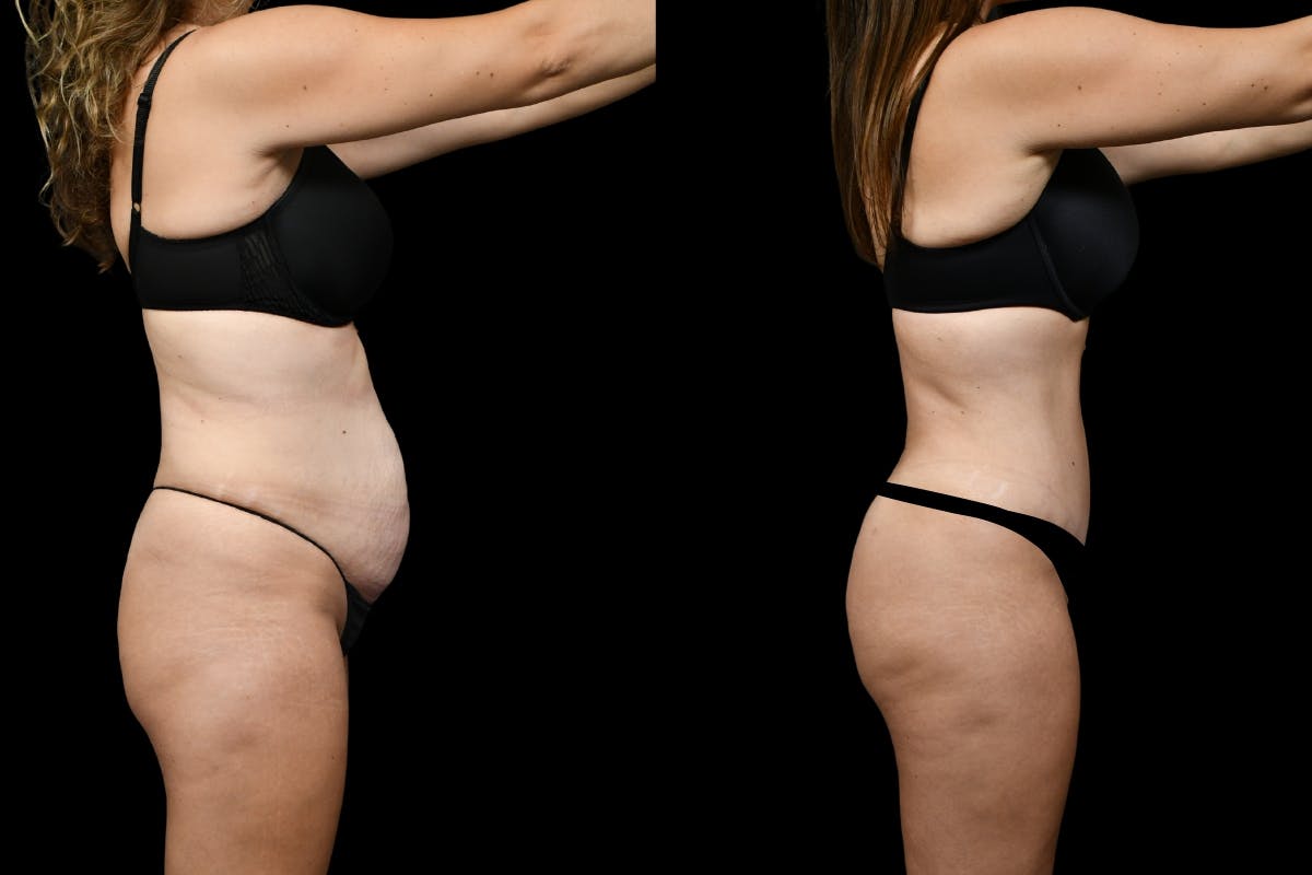 Tummy Tuck Before & After Gallery - Patient 193812 - Image 3