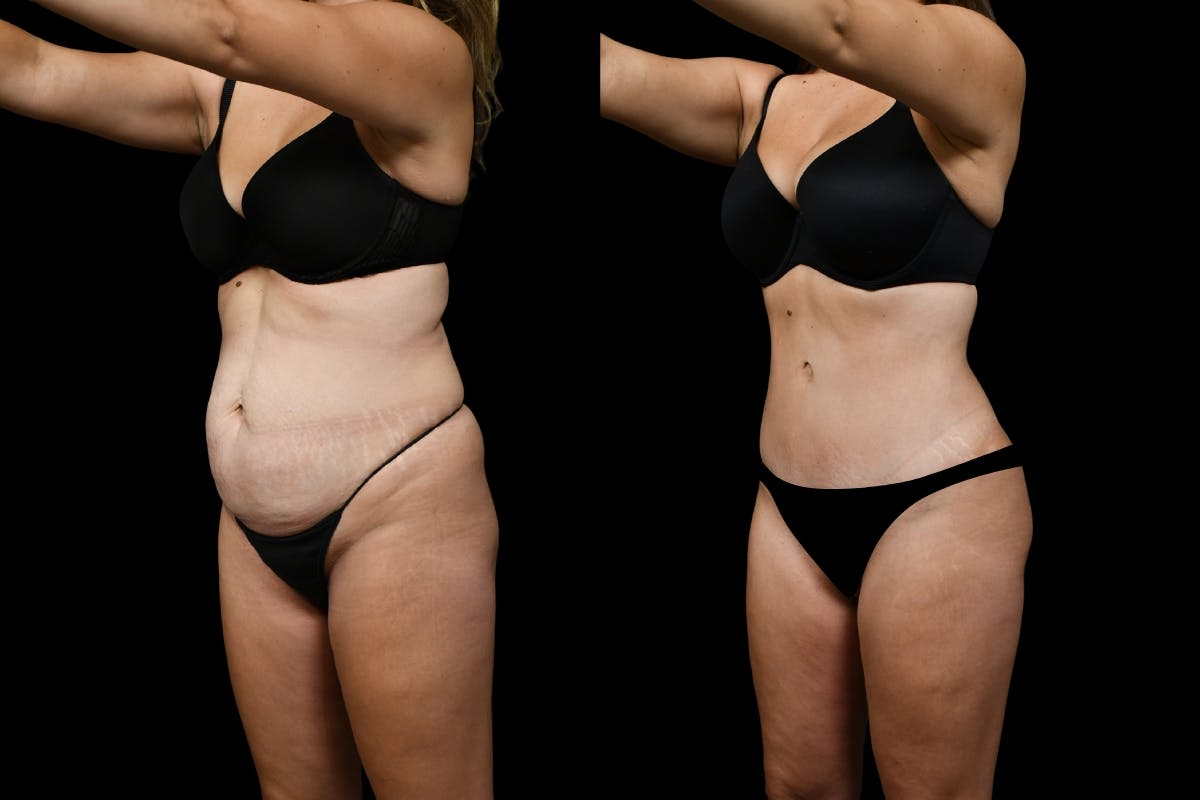 Tummy Tuck Before & After Gallery - Patient 193812 - Image 4
