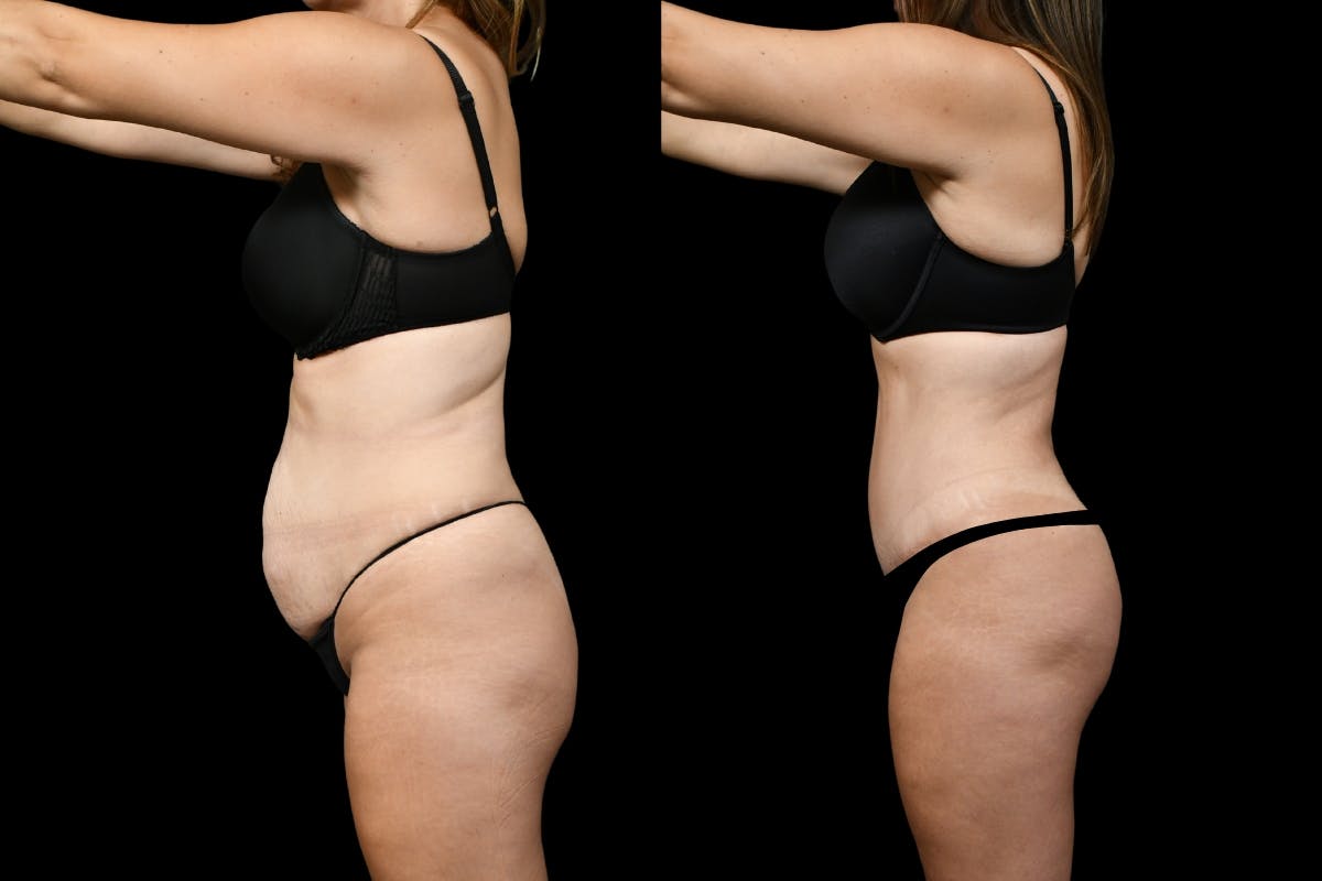 Tummy Tuck Before & After Gallery - Patient 193812 - Image 5