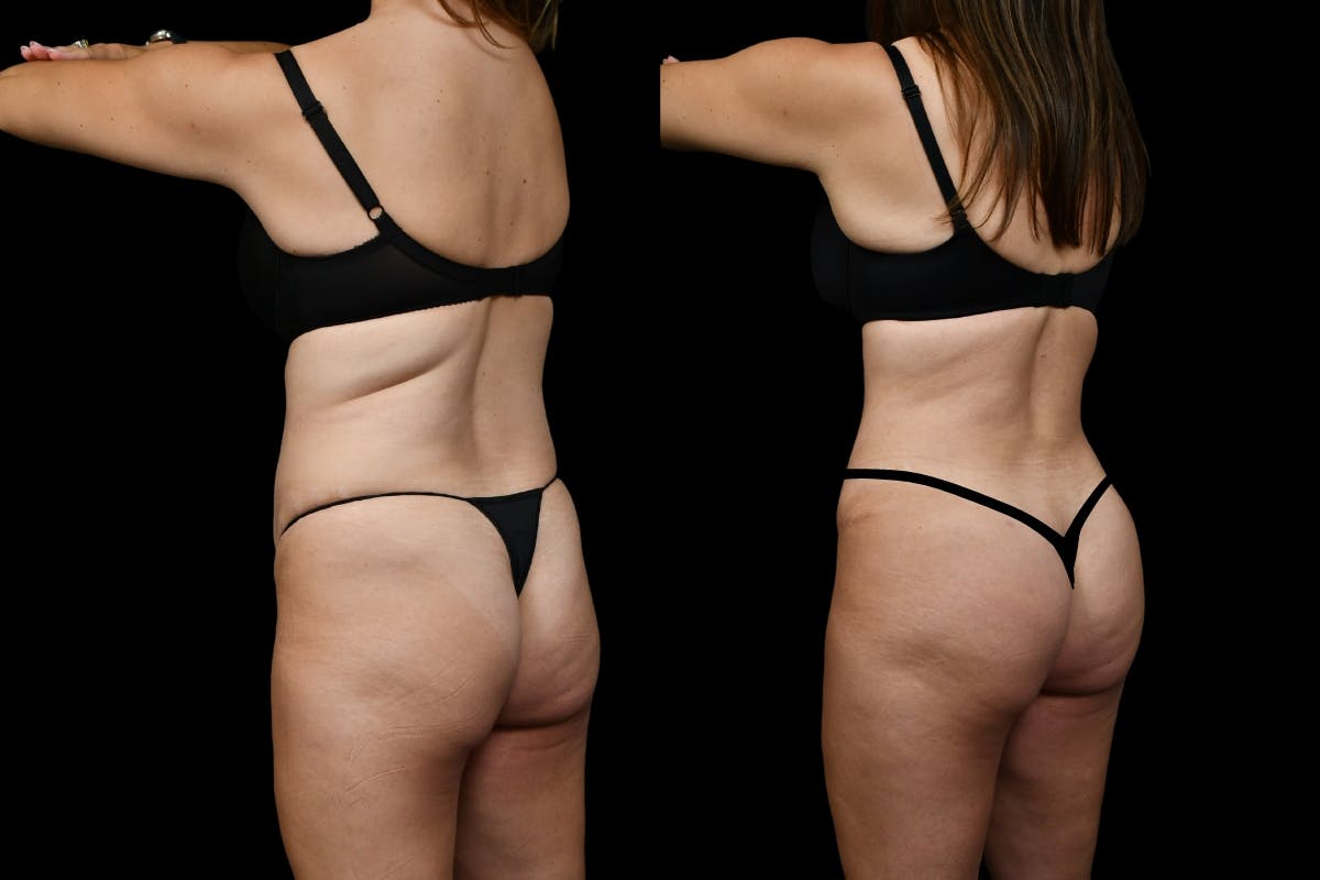 Tummy Tuck Before & After Gallery - Patient 193812 - Image 6